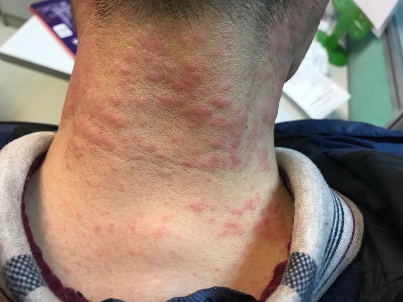 1、膏藥過敏怎么辦？
