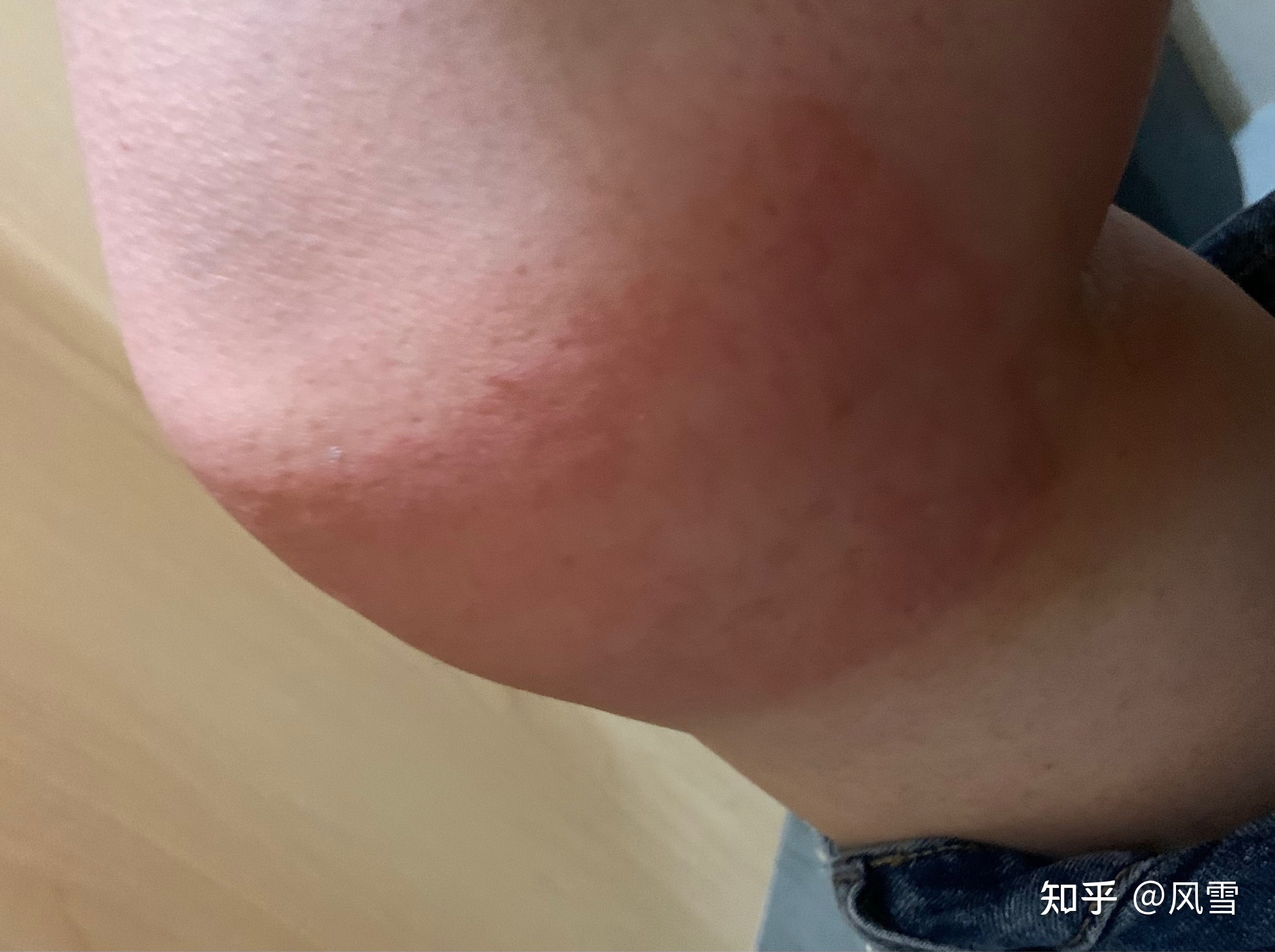 1、貼膏藥過敏癢紅腫怎么辦？