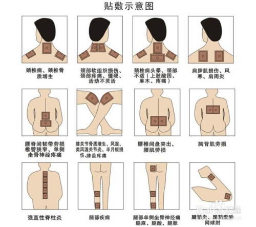 1、肩痛買什么膏藥可以貼？