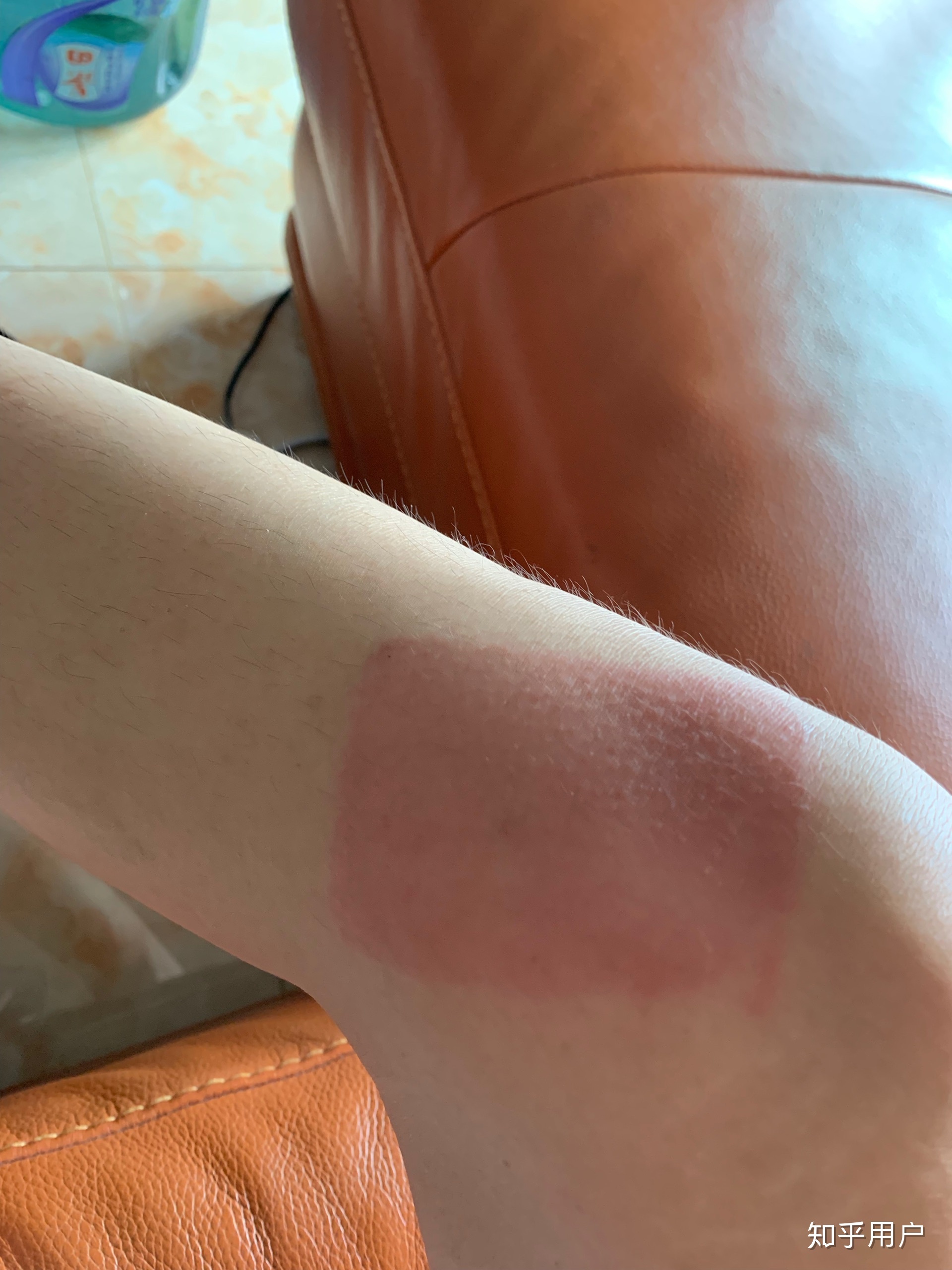 2、貼膏藥的地方有很多紅疙瘩，好不好？
